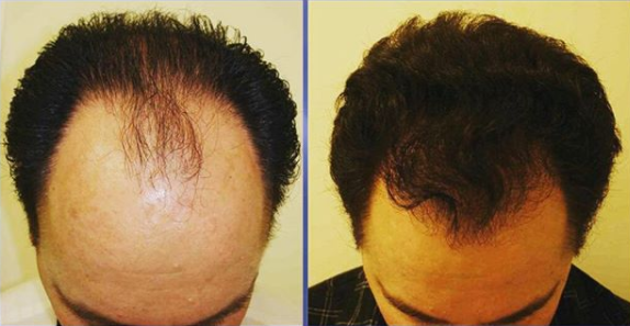 FUE transplant at Beverly Wilshire